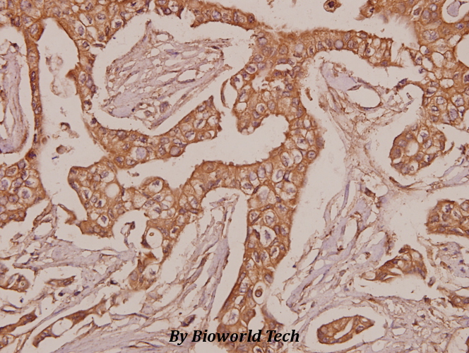 Immunohistochemistry (IHC) analyzes of Laminin-R (Q215) pAb in paraffin-embedded human breast carcinoma tissue at 1:50.