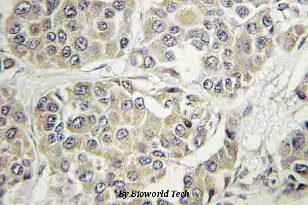 Immunohistochemistry (IHC) analyzes of Tyk 2 (V1048) pAb in paraffin-embedded human breast carcinoma tissue.
