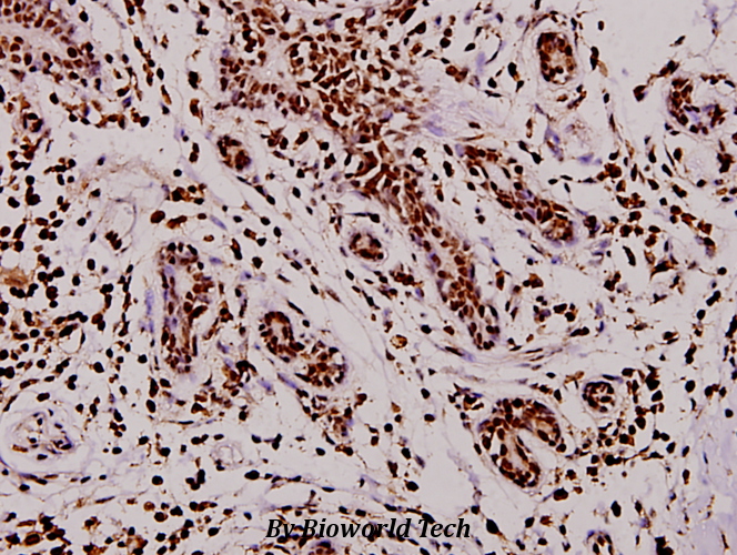 Immunohistochemistry (IHC) analyzes of TPH1 (V256) pAb in paraffin-embedded human breast carcinoma tissue at 1:100.