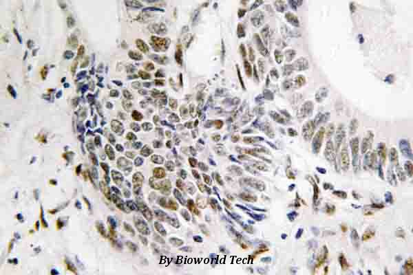 Immunohistochemistry (IHC) analyzes of Rad51 (T309) pAb in paraffin-embedded human colon carcinoma tissue.