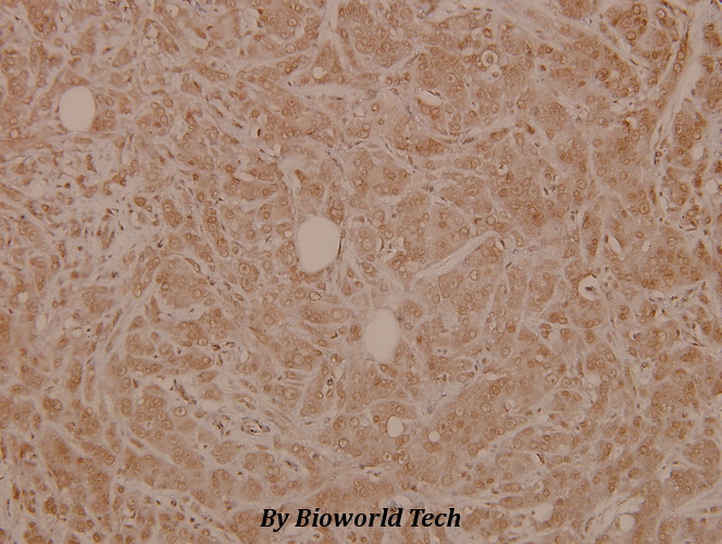 Immunohistochemistry (IHC) analyzes of SLP-76 (G122) pAb in paraffin-embedded human breast carcinoma tissue at 1:100.