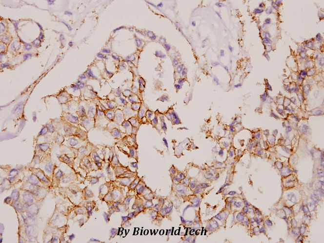 Immunohistochemistry (IHC) analyzes of Claudin-7 (S204) pAb in paraffin-embedded human breast carcinoma tissue at 1:50.