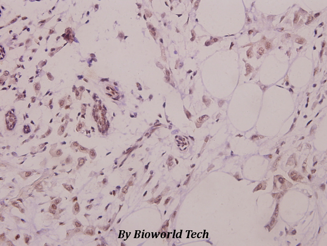 Immunohistochemistry (IHC) analyzes of Rad51 (L302) pAb in paraffin-embedded human colorectal carcinoma tissue at 1:50.