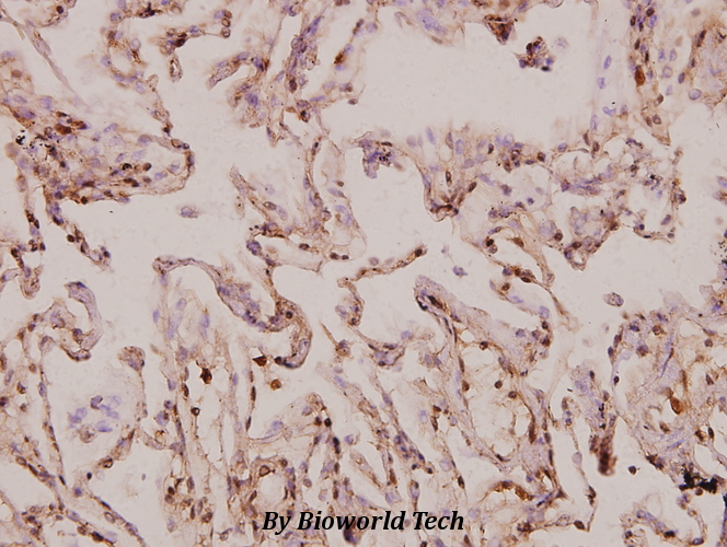 Immunohistochemistry (IHC) analyzes of MRP-S9 (F132) pAb in paraffin-embedded human lung carcinoma tissue at 1:100.