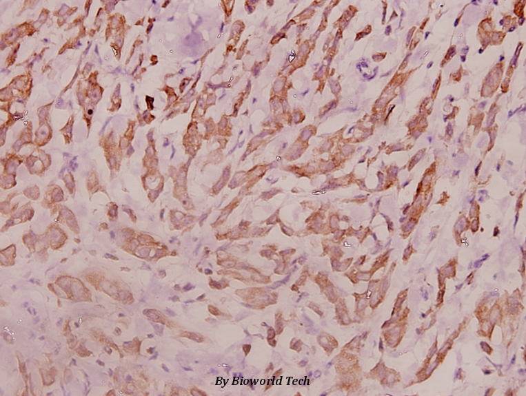 Immunohistochemistry (IHC) analyzes of RPL18 (H151) pAbb in paraffin-embedded human breast carcinoma tissue at 1:100.