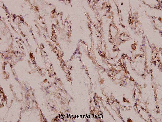 Immunohistochemistry (IHC) analyzes of X11γ (R401) pAb in paraffin-embedded human lung carcinoma tissue at 1:100.