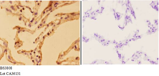 Immunohistochemistry (IHC) analyzes of APLP-2 (Y274) pAb in paraffin-embedded human lung carcinoma tissue at 1:50,showing cell membrane and nuclear staining.Negative control (the right)Using PBS instead of primary antibody, secondary antibody is Goat Anti-Rabbit IgG-biotin followed by avidin-peroxidase.