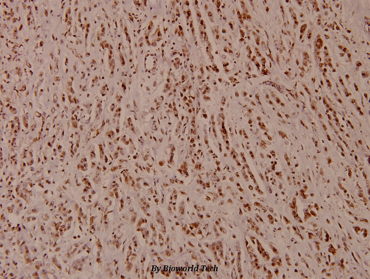 Immunohistochemistry (IHC) analyzes of ATP5H (D146) pAb in paraffin-embedded human breast carcinoma tissue at 1:100.