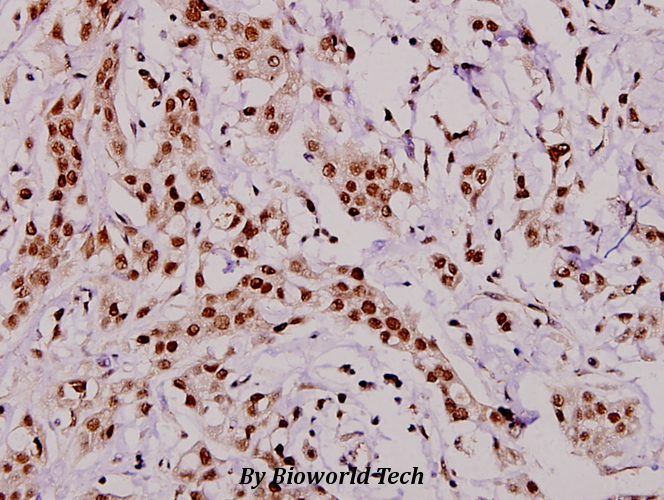 Immunohistochemistry (IHC) analyzes of C1q-C (Q119) pAb in paraffin-embedded human breast carcinoma tissue at 1:100.