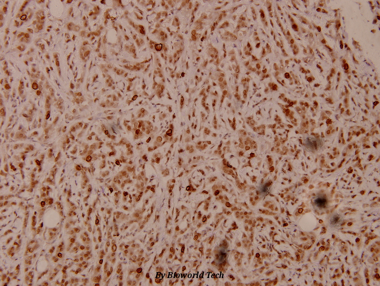 Immunohistochemistry (IHC) analyzes of Peroxin 7 (F236) pAb in paraffin-embedded human breast carcinoma tissue at 1:100.