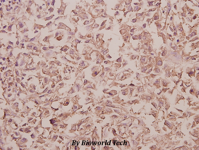 Immunohistochemistry (IHC) analyzes of Rab 5C (A153) pAb in paraffin-embedded human colorectal carcinoma tissue at 1:50.