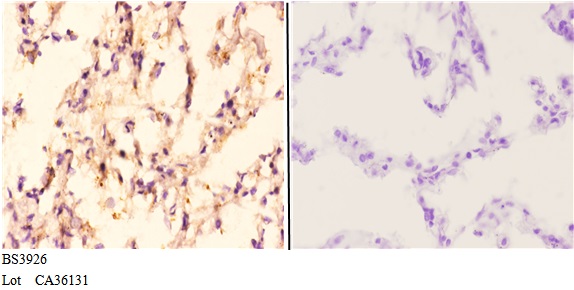 Immunohistochemistry (IHC) analyzes of ALDH1A2 (F443) pAb in paraffin-embedded human lung carcinoma tissue at 1:50,showing cytoplasmic staining.Negative control (the right)Using PBS instead of primary antibody, secondary antibody is Goat Anti-Rabbit IgG-biotin followed by avidin-peroxidase.