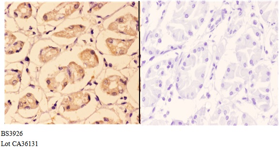 Immunohistochemistry (IHC) analyzes of ALDH1A2 (F443) pAb in paraffin-embedded human stomach carcinoma tissue at 1:50,showing cytoplasmic staining.Negative control (the right)Using PBS instead of primary antibody, secondary antibody is Goat Anti-Rabbit Ig