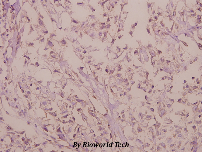 Immunohistochemistry (IHC) analyzes of Rho G (Q132) pAb in paraffin-embedded human colorectal carcinoma tissue at 1:50.
