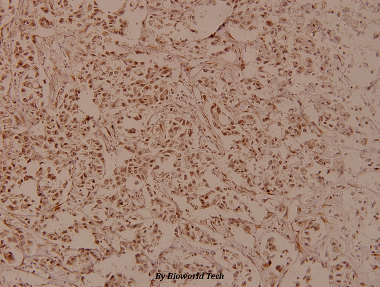 Immunohistochemistry (IHC) analyzes of RRS1 (R286) pAb in paraffin-embedded human breast carcinoma tissue at 1:100.