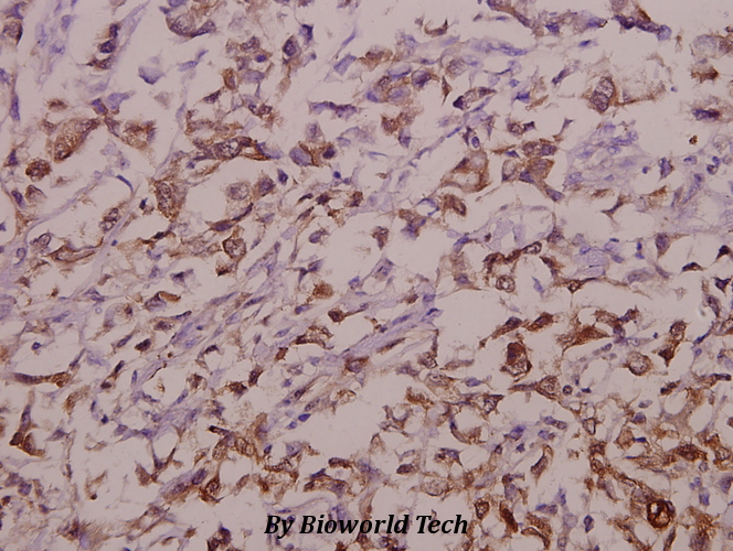 Immunohistochemistry (IHC) analyzes of OATP1 (N286) pAb in paraffin-embedded human colorectal carcinoma tissue at 1:50.