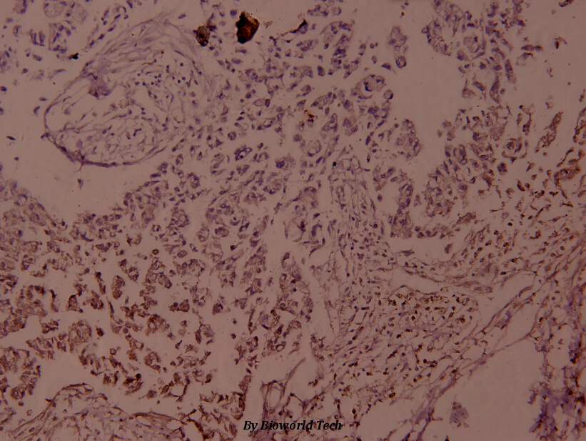 Immunohistochemistry (IHC) analyzes of p-JunD (S255) pAb in paraffin-embedded human breast carcinoma tissue at 1:100.