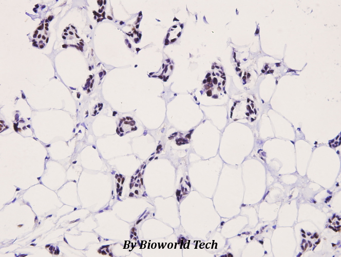Immunohistochemistry (IHC) analyzes of p-LIMK2 (T505) pAb in paraffin-embedded human breast carcinoma tissue at 1:100.