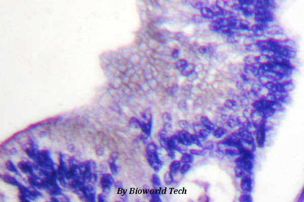 Immunohistochemistry (IHC) analyzes of p-PLCG1 (Y783) pAb in paraffin-embedded human breast carcinoma tissue.