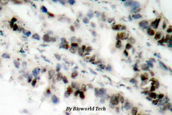 Immunohistochemistry (IHC) analysis of p-SMC1 (S957) pAb in paraffin-embedded human lung carcinoma tissue.