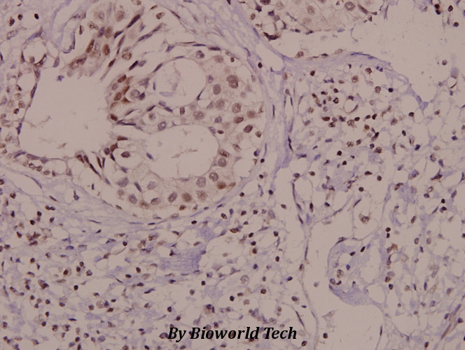 Immunohistochemistry (IHC) analyzes of p-Vav (Y174) pAb in paraffin-embedded human breast carcinoma tissue at 1:50.
