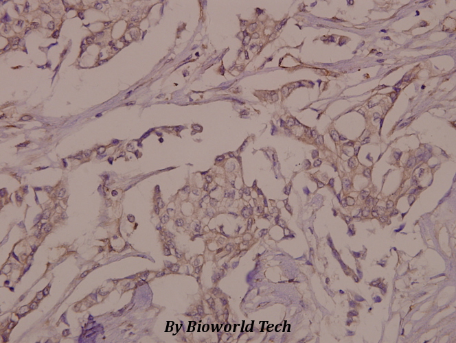 Immunohistochemistry (IHC) analyzes of p-VE-Cadherin (Y731) pAb in paraffin-embedded human breast carcinoma tissue at 1:50.