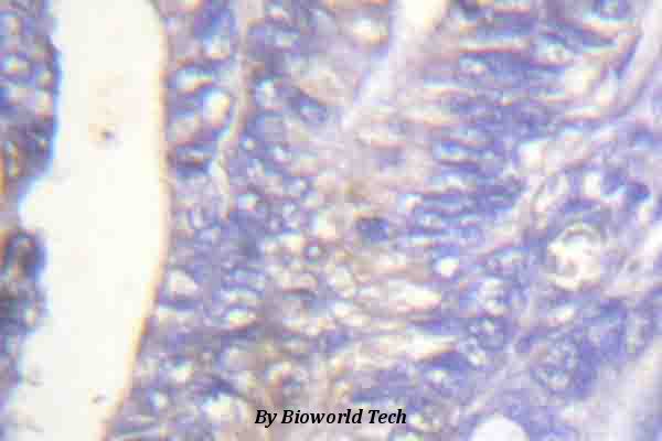 Immunohistochemistry (IHC) analyzes of p-PLC γ2 (Y753) pAb in paraffin-embedded human colon cancer tissue.