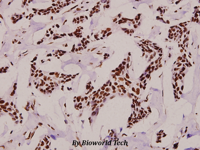 Immunohistochemistry (IHC) analyzes of p-Rpb1 (S1619) pAb in paraffin-embedded human breast carcinoma tissue at 1:100.