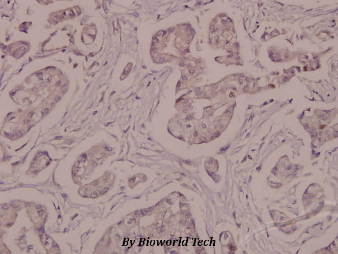Immunohistochemistry (IHC) analyzes of p-Na+/K+-ATPase α1 (S16) pAb in paraffin-embedded human breast carcinoma tissue at 1:50.