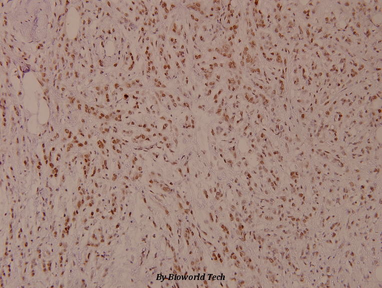 Immunohistochemistry (IHC) analyzes of p-MITF (S180) pAb in paraffin-embedded human breast carcinoma tissue at 1:100.