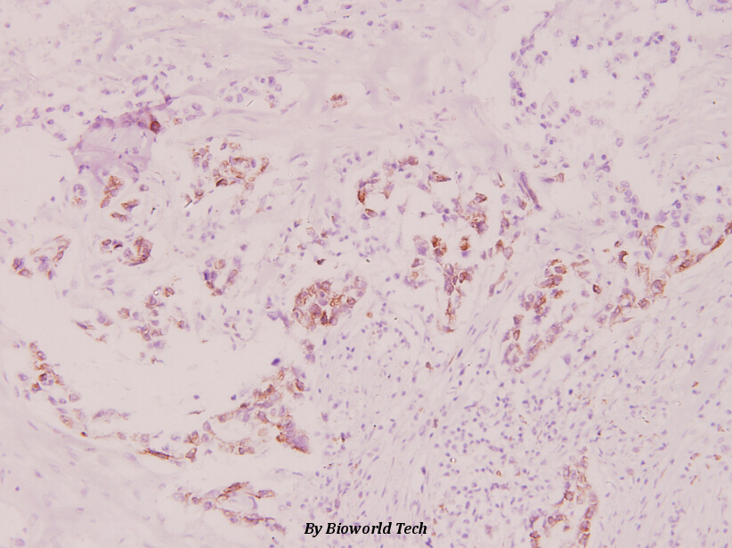 Immunohistochemistry (IHC) analyzes of p-RPS6 (S240) pAb in paraffin-embedded human breast carcinoma tissue at 1:100.
