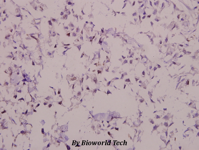 Immunohistochemistry (IHC) analyzes of p-PLC β3 (S1105) pAb in paraffin-embedded human breast carcinoma tissue at 1:50.