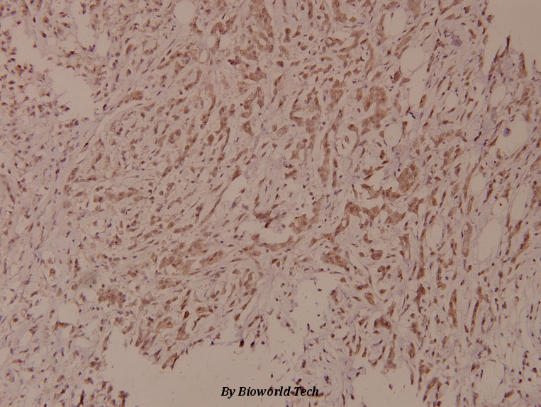 Immunohistochemistry (IHC) analyzes of p-PLC γ1 (Y771) pAb in paraffin-embedded human breast carcinoma tissue at 1:100.