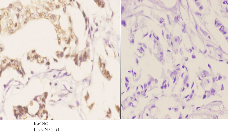 Immunohistochemistry (IHC) analyzes of p-FANCA (S1149) pAb in paraffin-embedded human breast carcinoma tissue at 1:50.showing cytoplasmic and nucleus staining. Negative control (the right)Using PBS instead of primary antibody, secondary antibody is Goat Anti-Rabbit IgG-biotin followed by avidin-peroxidase.