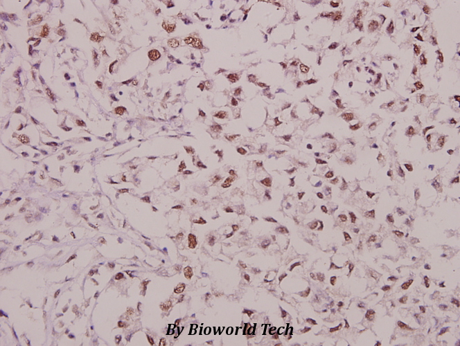 Immunohistochemistry (IHC) analyzes of p-GluR1 (S863) pAb pAb in paraffin-embedded human breast carcinoma tissue at 1:50.