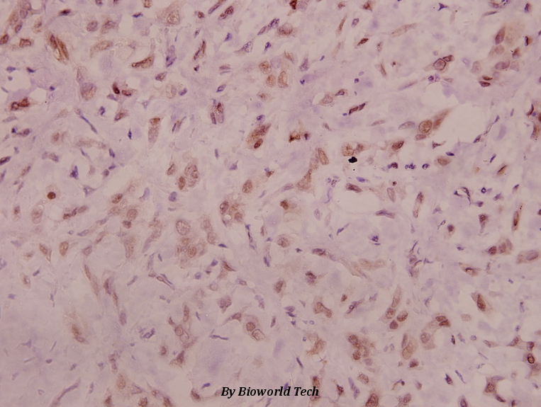 Immunohistochemistry (IHC) analyzes of p-NMDAζ1 (S896) pAb in paraffin-embedded human breast carcinoma tissue at 1:100.
