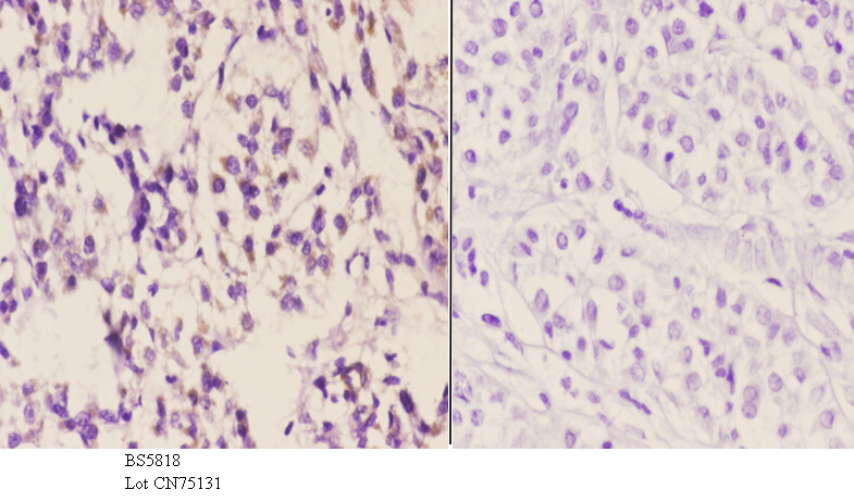 Immunohistochemistry (IHC) analyzes of NDUFS1 pAb in paraffin-embedded human liver carcinoma tissue at 1:50.showing Mitochondrion inner membrane staining. Negative control (the right)Using PBS instead of primary antibody, secondary antibody is Goat Anti-Rabbit IgG-biotin followed by avidin-peroxidase.