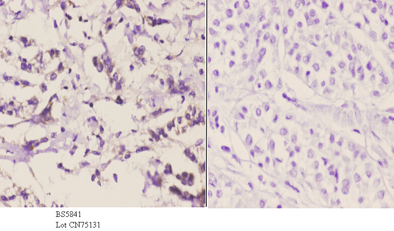 Immunohistochemistry (IHC) analyzes of PCB pAb in paraffin-embedded human liver carcinoma tissue at 1:50.showing cytoplasmic staining. Negative control (the right)Using PBS instead of primary antibody, secondary antibody is Goat Anti-Rabbit IgG-biotin followed by avidin-peroxidase.