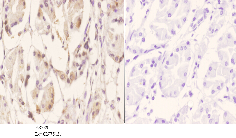 Immunohistochemistry (IHC) analyzes of RGS10 pAb in paraffin-embedded human stomach carcinoma tissue at 1:50.showing cytoplasmic and nucleus staining. Negative control (the right)Using PBS instead of primary antibody, secondary antibody is Goat Anti-Rabbi