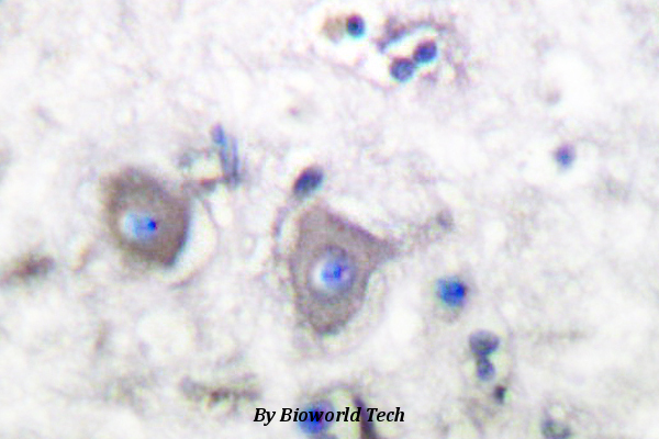 Immunohistochemistry (IHC) analysis of Cleaved-Notch 2 (D1733) pAb in paraffin-embedded human lung carcinoma tissue.