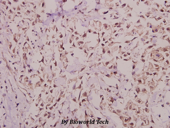 Immunohistochemistry (IHC) analyzes of Hairless (E77) pAb in paraffin-embedded human breast carcinoma tissue at 1:50.