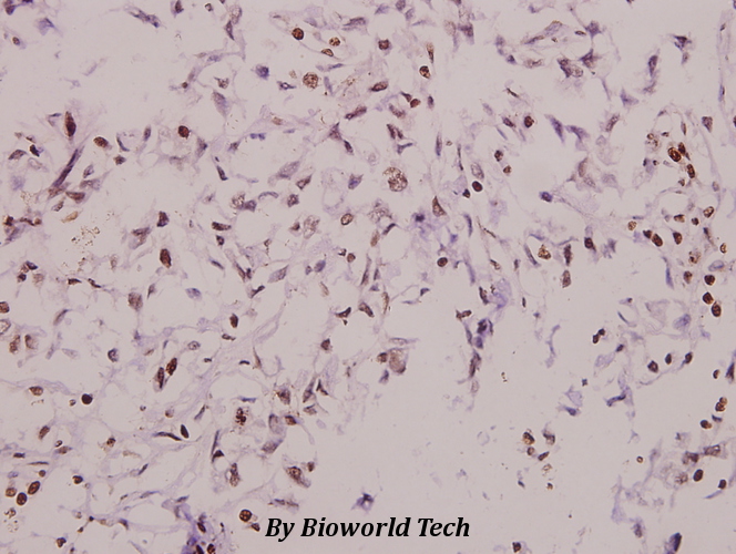 Immunohistochemistry (IHC) analyzes of DUSP6 (L76) pAb in paraffin-embedded human breast carcinoma tissue at 1:50.
