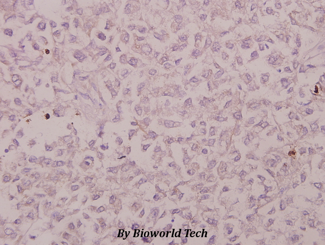 Immunohistochemistry (IHC) analyzes of CRSP130 (F26) pAb in paraffin-embedded human colorectal carcinoma tissue at 1:50.