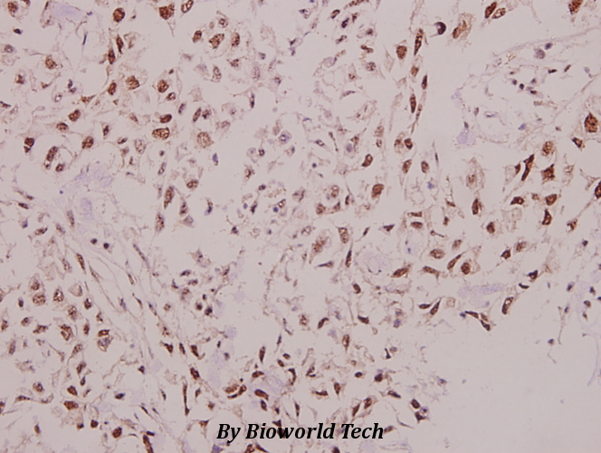 Immunohistochemistry (IHC) analyzes of p57 (D38) pAb in paraffin-embedded human breast carcinoma tissue at 1:50.
