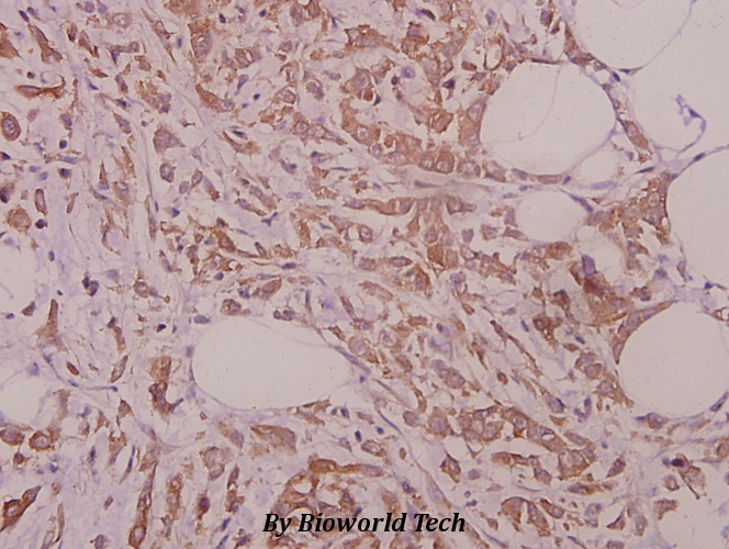 Immunohistochemistry (IHC) analyzes of eRF3a (D128) pAb in paraffin-embedded human colorectal carcinoma tissue at 1:50.