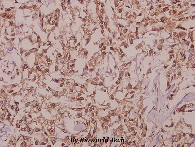 Immunohistochemistry (IHC) analyzes of DDX19B (V38) pAb in paraffin-embedded human colorectal carcinoma tissue at 1:50.