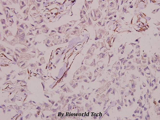 Immunohistochemistry (IHC) analyzes of MIPP (I360) pAb in paraffin-embedded human breast carcinoma tissue at 1:50.