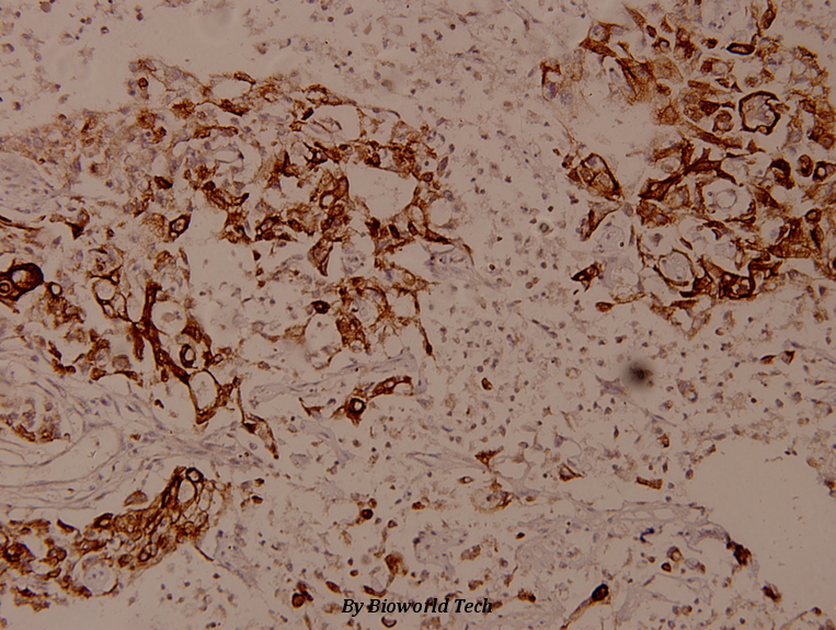Immunohistochemistry (IHC) analyzes of LEKTI (H525) pAb in paraffin-embedded human breast carcinoma tissue at 1:100.