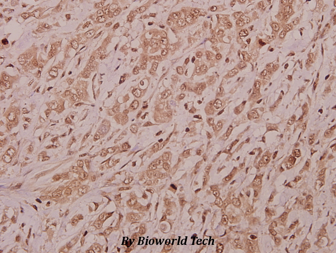 Immunohistochemistry (IHC) analyzes of CSRNP2 (K127) pAb in paraffin-embedded human colorectal carcinoma tissue at 1:50.