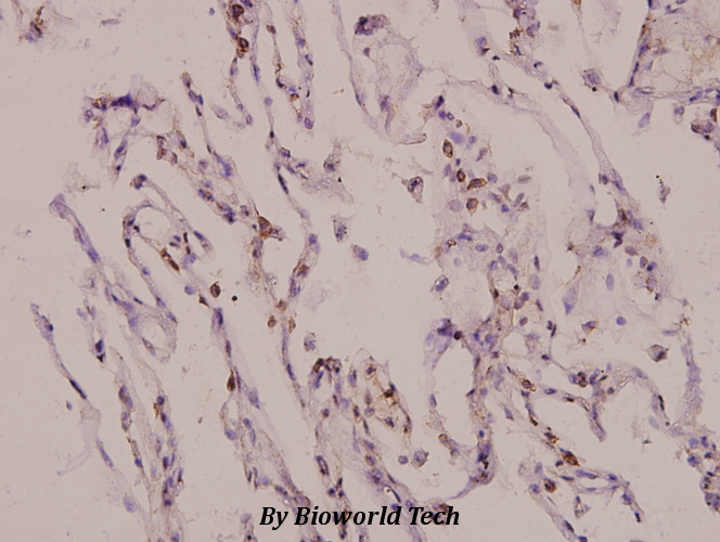 Immunohistochemistry (IHC) analyzes of Lsk (V157) pAb in paraffin-embedded human lung carcinoma tissue at 1:100.